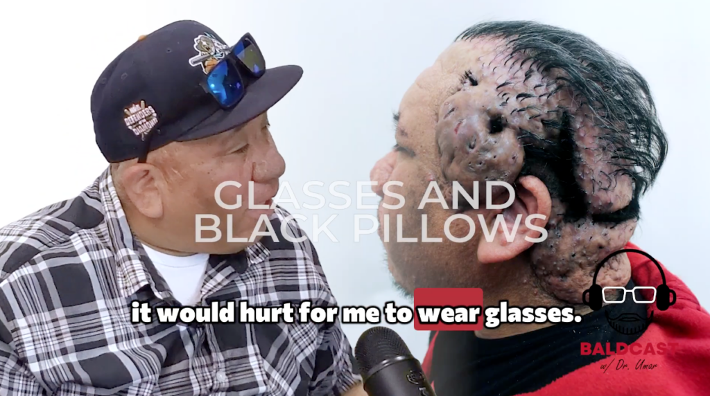 Robert explains how advanced AKN made it impossible for him to comfortably wear prescription glasses or sunglasses.