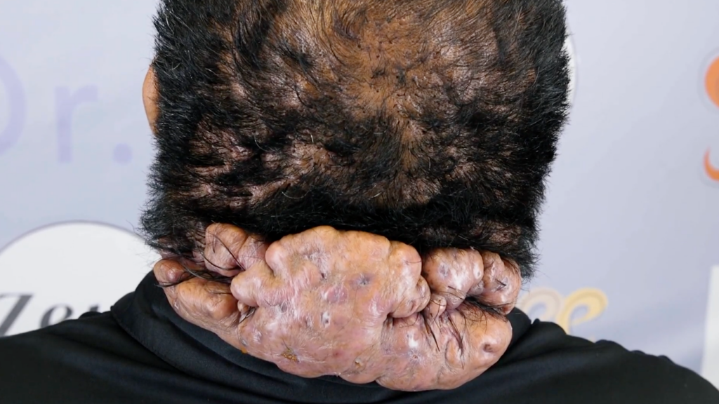 Severe acne keloidalis nuchae, folliculitis decalvans, and cutis verticis gyrata affecting the back of John's scalp before treatment.