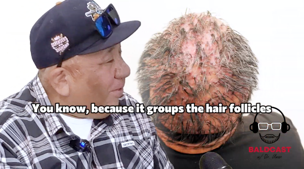 Robert describing tufted hair growth caused by severe folliculitis keloidalis nuchae on his scalp.